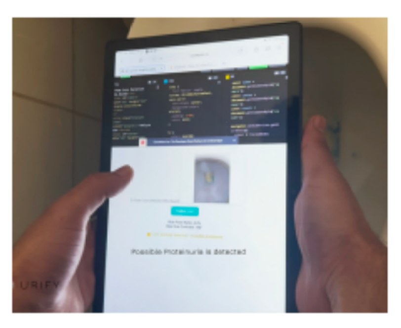 Two hands holding a tablet computer. The top half shows the code running, and the bottom half shows the app's result screen with a photo of the test and the message 'Possible Proteinuria is detected'
