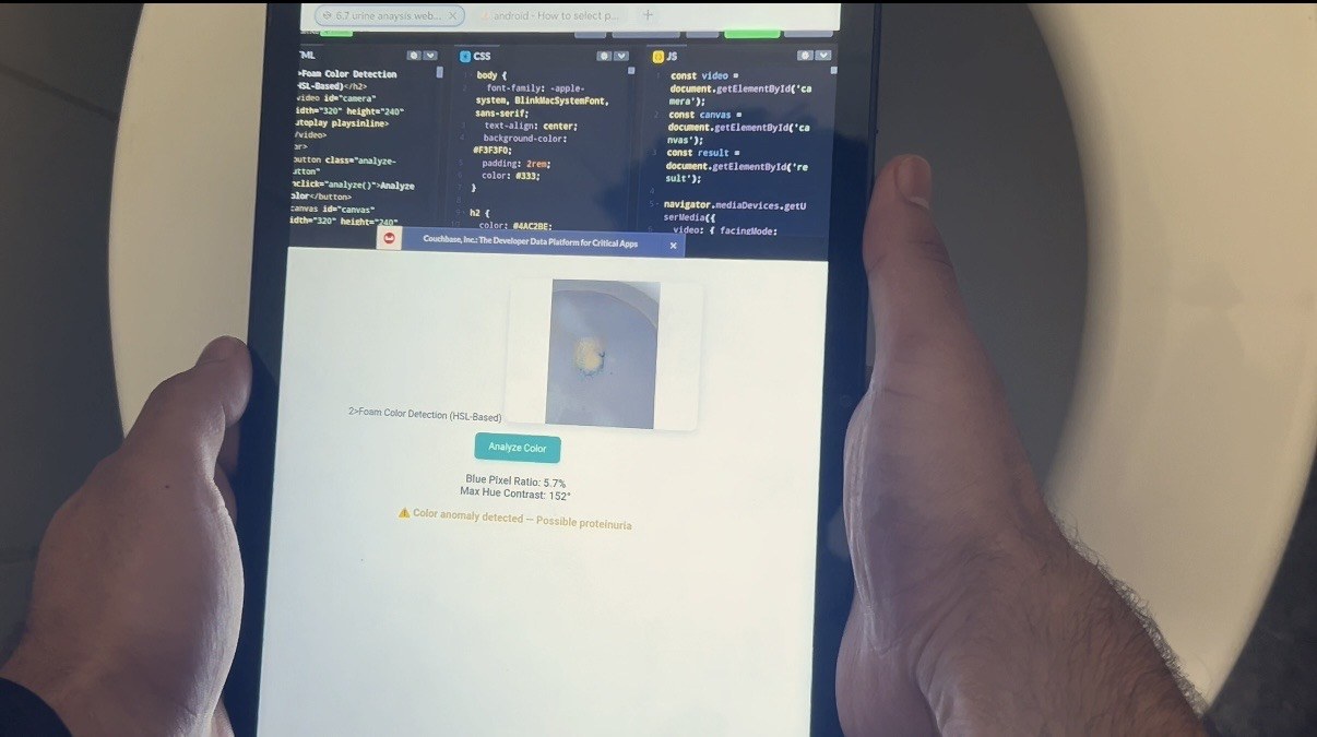 Two hands holding a tablet over a toilet. The top of the screen shows the running code, and the result panel below reports a blue pixel ratio of 5.7 per cent, a max hue contrast of 152 degrees, and the line 'Color anomaly detected, possible proteinuria'